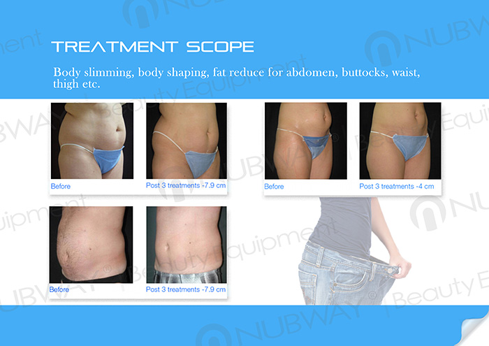 2017 most effect HIFUShape machine for body slimming and body shaping