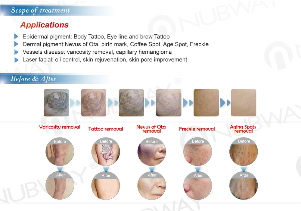 Best effective nd yag laser tattoo removal machine / q switch nd yag laser pigments removal machine