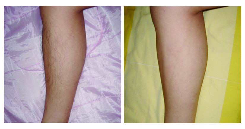 Medical Ipl Shr Hair Removal Machine , Vertical Type Ipl Hair Reduction Machine