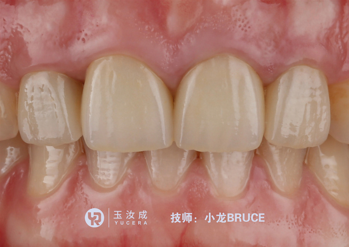 Yucera Multilayer Zirconia Block 43%-57% 700Mpa-1050Mpa Dental Zirconia Ceramic Disc