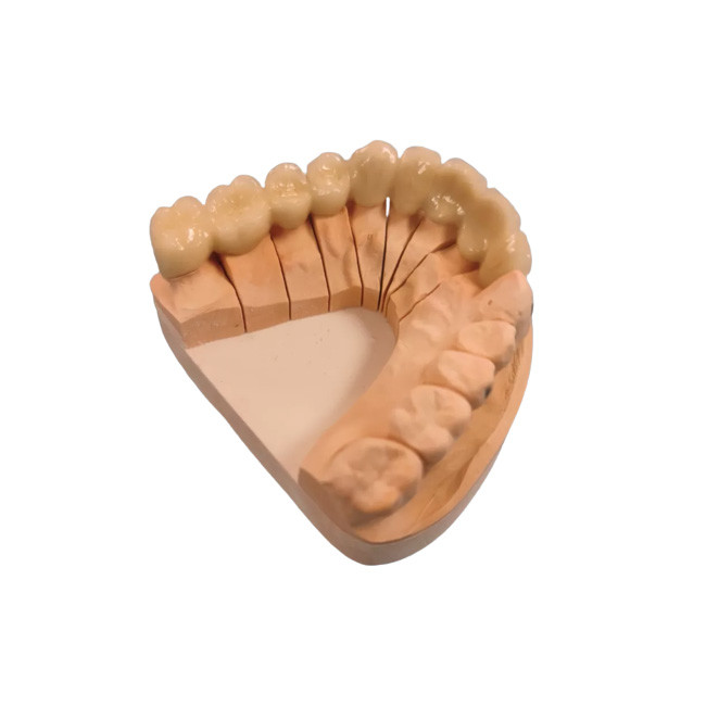 High Strength Metal Porcelain Crown PFM Dental Crown Color Stable Smooth Surface