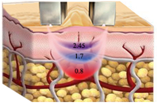 Channeling Optimized Non - Invasive RF Beauty Machine For Skin Rejuvenation