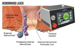 China Dual Wavelength Medical Diode Laser wholesale