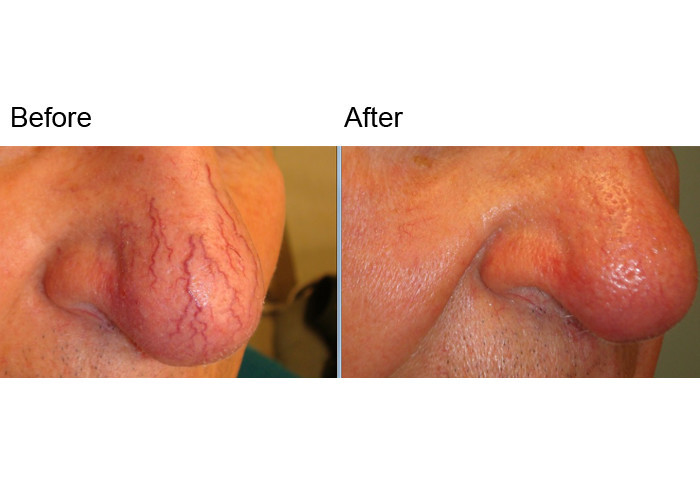 940nm At Home Spider Vein Removal Machine 15 Watt Pain Free Laser Therapy