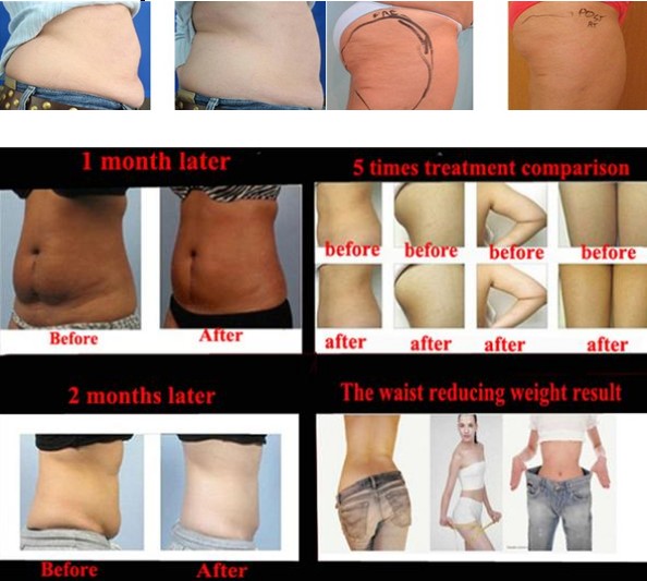 Portable Cryolipolysis Slimming + Lipolaser Machine for Body Slimming and Weight Loss
