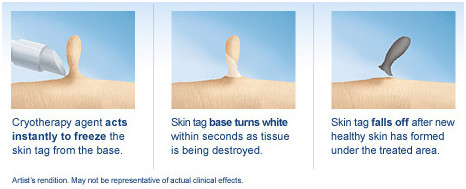 Laser treatment for varicose veins Best treatment for varicose and spider veins