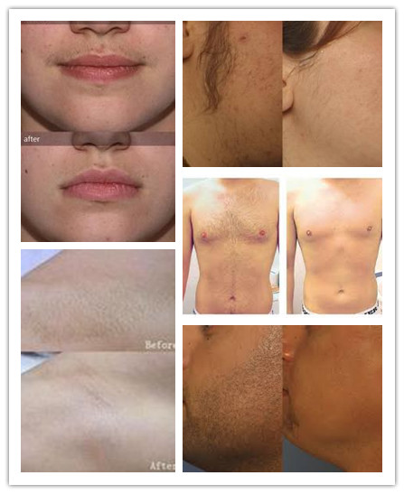 painless 808nm diode laser hair removal permanently
