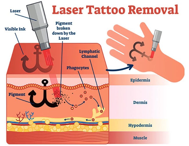 CE Approved Infrared Acne Removal ND YAG Laser Machine