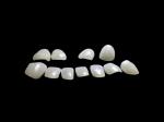 Minimal Preparation Porcelain EMAX Veneer For Cosmetic Dental Treatment