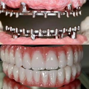China Dental Hybird Malo Implant Bridge Professional Perfect Fit FDA Certified wholesale