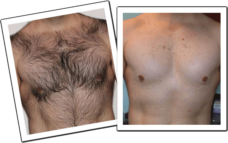 FDA Approved Professional Laser Hair Removal Machines For Ladies 690-1200nm