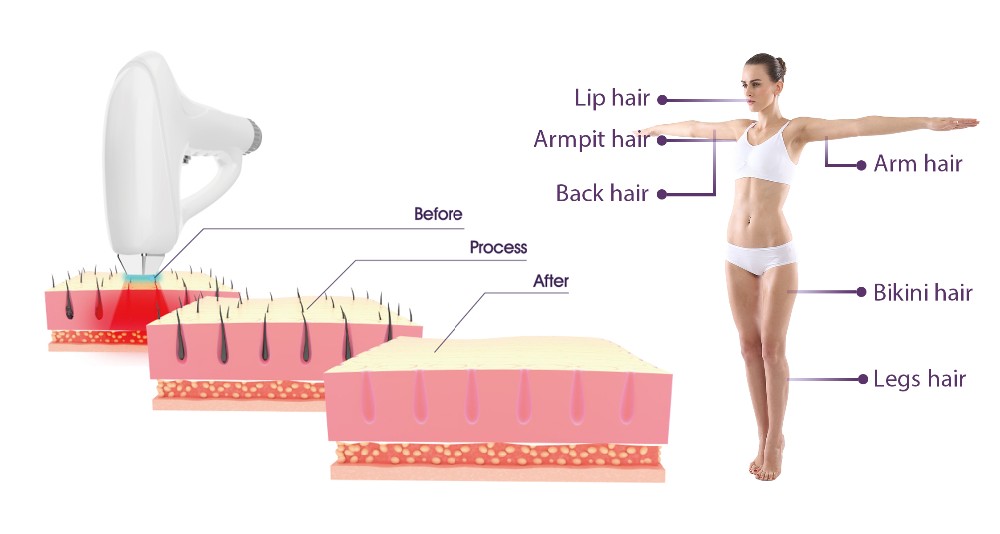 Diode Laser Hair Removal Machine triple wavelength lady hair removal machine