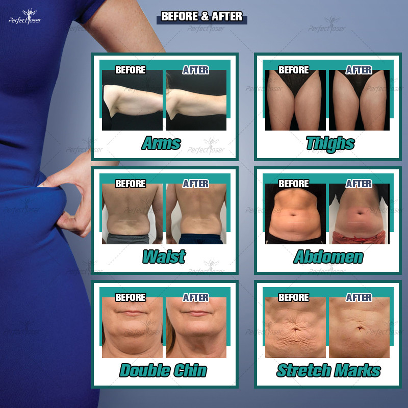 360 Cryolipolysis Slimming Machine Coolsculpting Weight Loss 0kpa - 100kpa