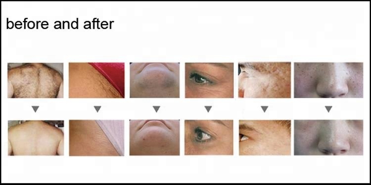 3 In 1 IPL Laser Beauty Machine , Intense Pulsed Light Hair Removal Machine
