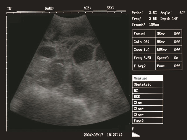 Palm Ultrasound ScannerSU-V5(ultrasonic,black white,Imaging System)