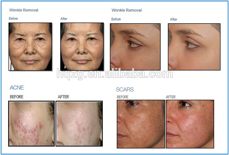 Globalipl 2018 Professional CE Approved Fractional CO2 Laser Acne Treatment Machine/Acne Laser
