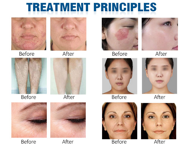 Ipl Hair Removal Machine / Ipl Hair Removal Machine Ice Cool / Ipl
