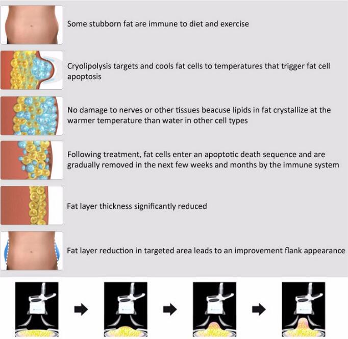 2017 Hottest fat freezing liposuction machine