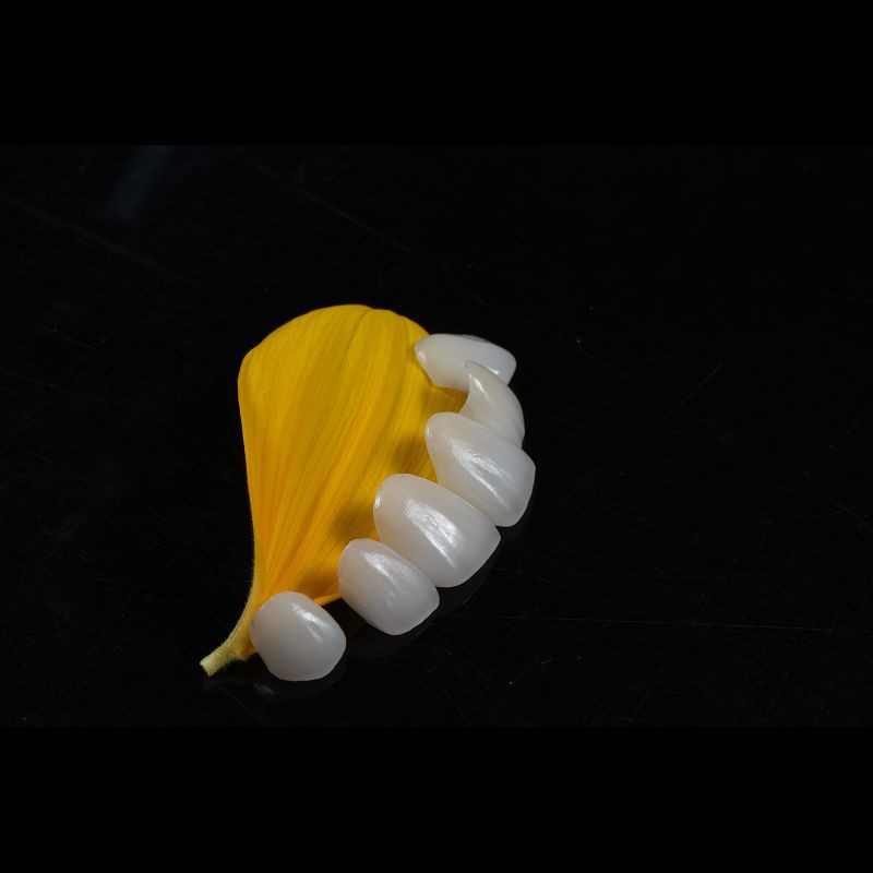Seamless Porcelain Emax Veneers Teeth Replacement Authentic Looking