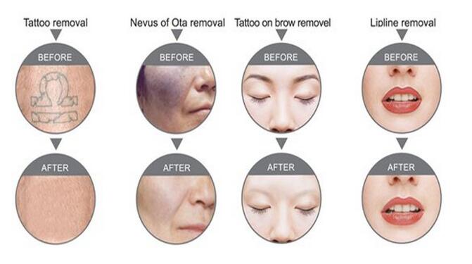 New design hot sale Laser nd yag q-switched tattoo removal machine