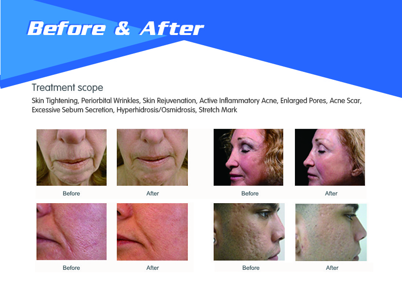 Scarlet microneedle rf radio frequency fractional skin resurfacing max rf skin treatment