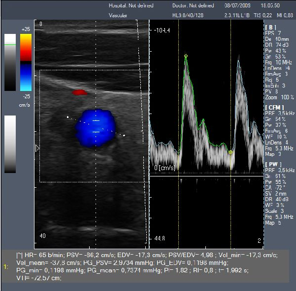 Touch screen color doppler,Protable color doppler,22" color doppler with convet probe SGC6