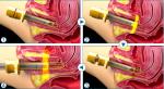 2017 New Arrivals! USA RF Tube Laser Cutting, Fractional, Vaginal treatment