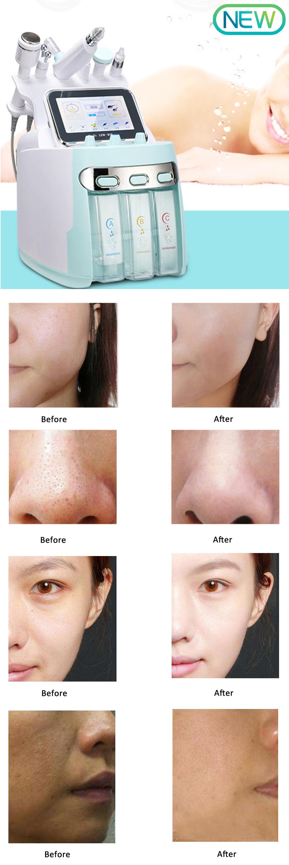 Supersonic RF Body Slimming Machine Radio Frequency Skin Tightening Machine