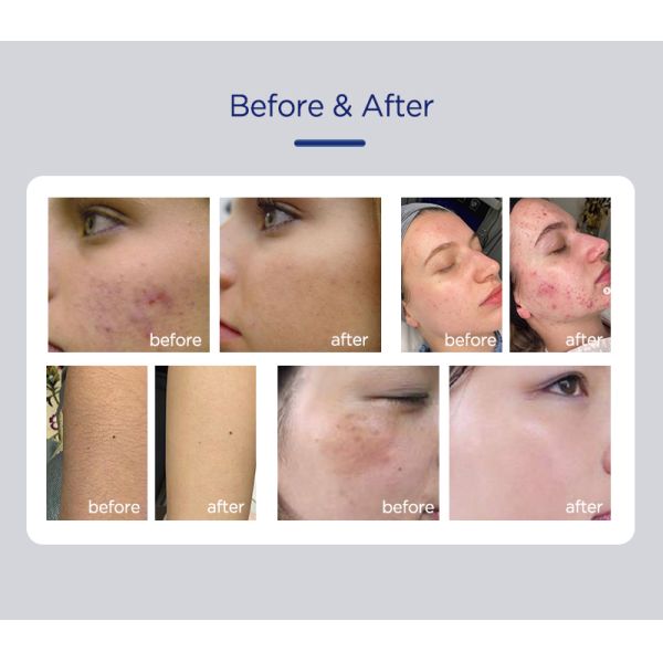 ADSS Hot Sale Ipl Laser Hair Removal Machine Use for Hair Removal Skin Rejuvenation and Hair Removal