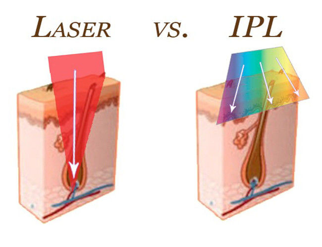 1000000 Shots IPL Hair Removal Machine