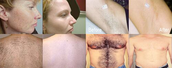 Best selling painless Crystal light guide laser hair removal SHR + IPL Multifunction Machine with CE FDA approved