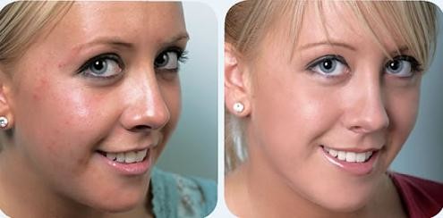 Fractional radiofrequency micro needling skin maintenance microneedle nurse system
