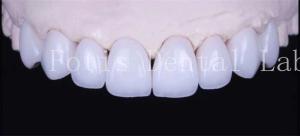China Adhesive Bonding Cement Natural White Veneers With High Translucency wholesale