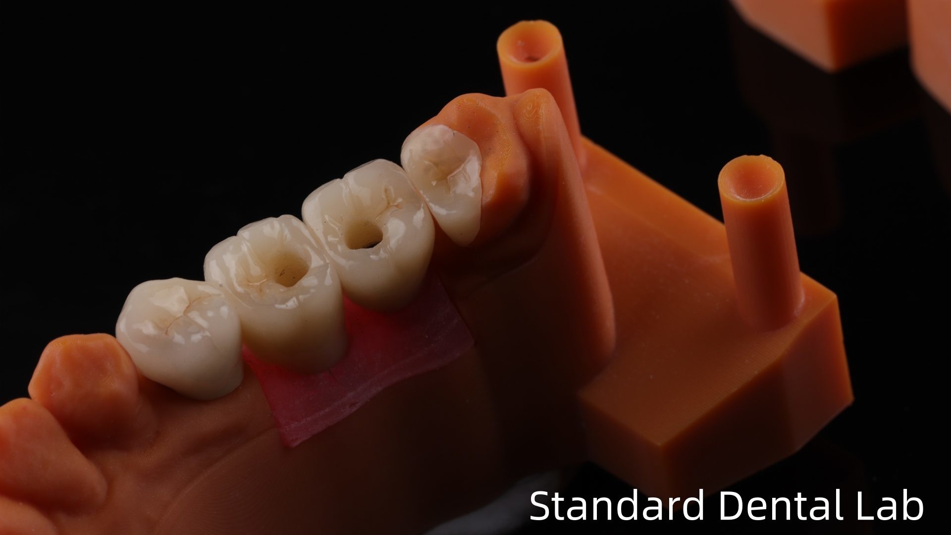Screw Retained Dental Implant Crown with PFZ Porcelain Layered Zirconia 5-Year Gurantee and 3D Print Model
