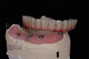 China Customizable All On 4 All On 6 Dental Implants For Complete Oral Rehabilitation wholesale