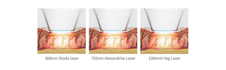 755nm 808nm 1064nm Diode Laser Hair Removal Machine Permanent Hair Remover Machine