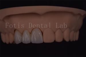 China ISO Certified Digital Dental Crowns For Tooth Implant Various Size wholesale
