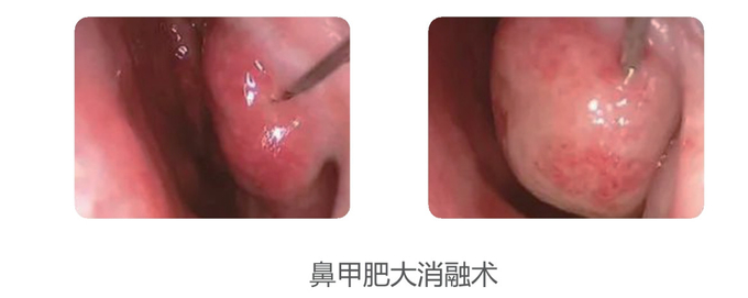 Cryogenic Radio Frequency Plasma Surgery System Minimal Invasive