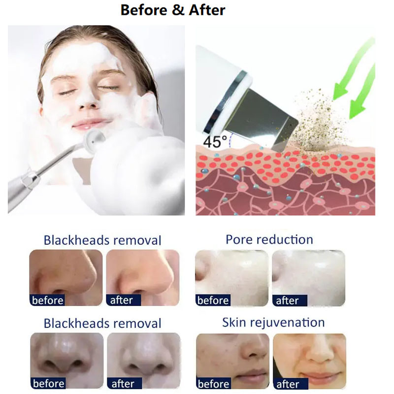 CE H2O2 Hydrafacial Machine Dermabrasion Ultrasound Skin Scrubber Vibration Cleaning Oxygen Jet Peel Machine
