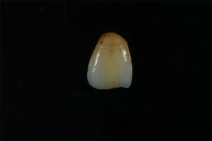 China ADS Dental Lab Dental Veneer Zirconia Stain Lifelike Finish OEM wholesale