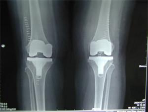 China 14*17inch agfa high quality Dry Digital X ray Film wholesale