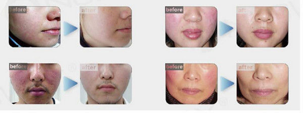 Varicose veins laser treatment machine spider veins on face removal laser surgery for varicose veins
