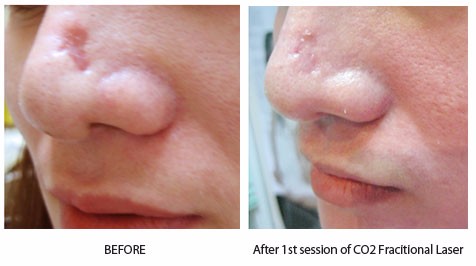 Fractional Co2 Laser Skin Resurfacing Machine , Viginal Tightening Machine CE FDA