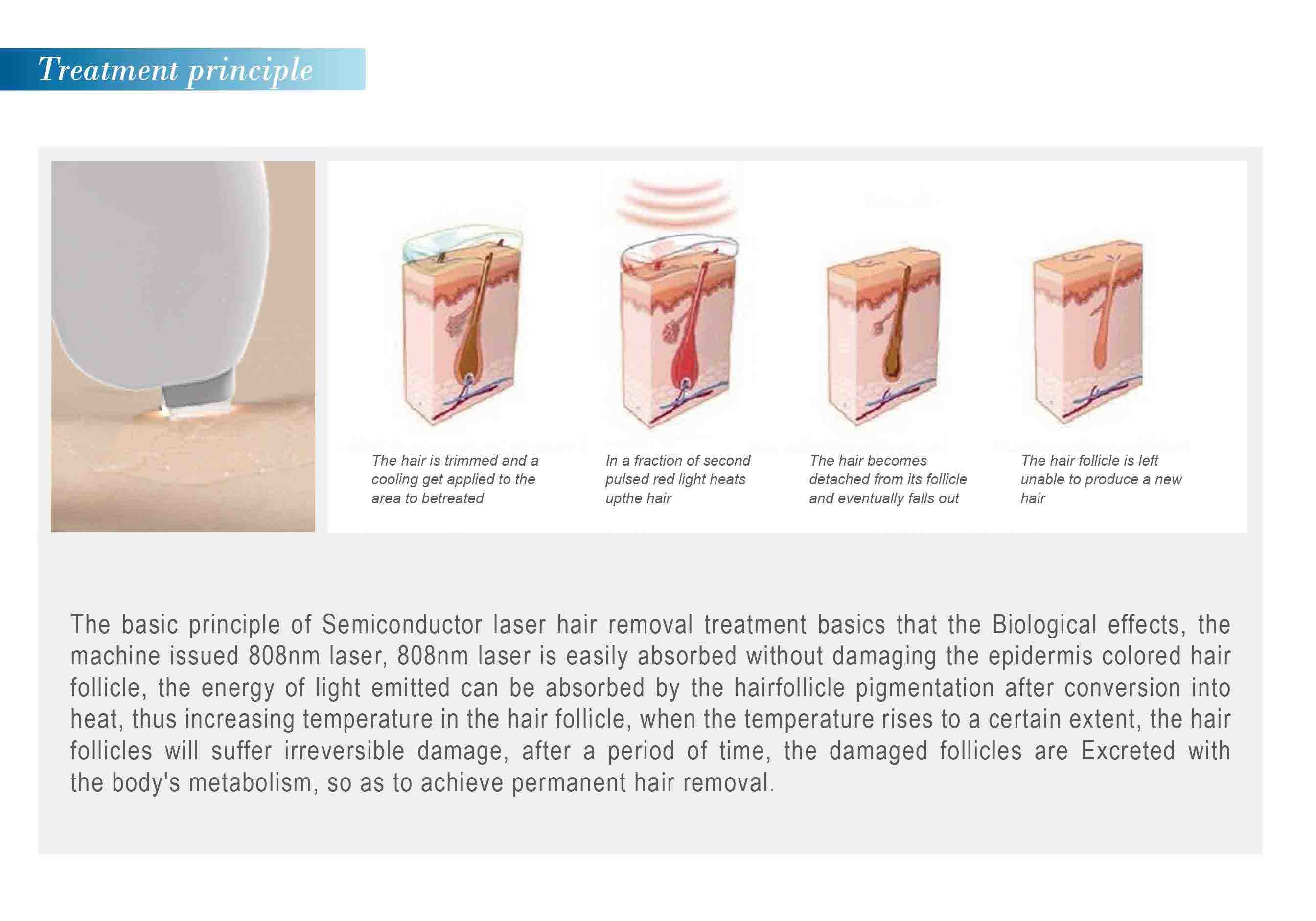 Alexandrite laser 755nm hair removal equipment professional laser hair removal