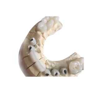 China Metal Free White Zirconia Dental Crowns Excellent Biocompatibility wholesale
