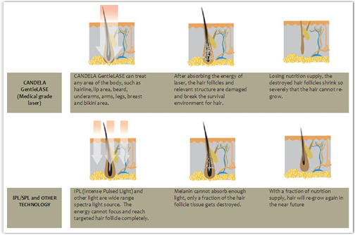 strong power painless portable 808nm diode laser hair removal device for salon use