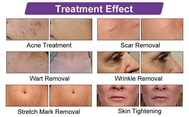 V11 Factory Price Skin Rejuvenation Tightening Resurfacing Acne Treatment Fractional Laser Machine For Beauty Salon
