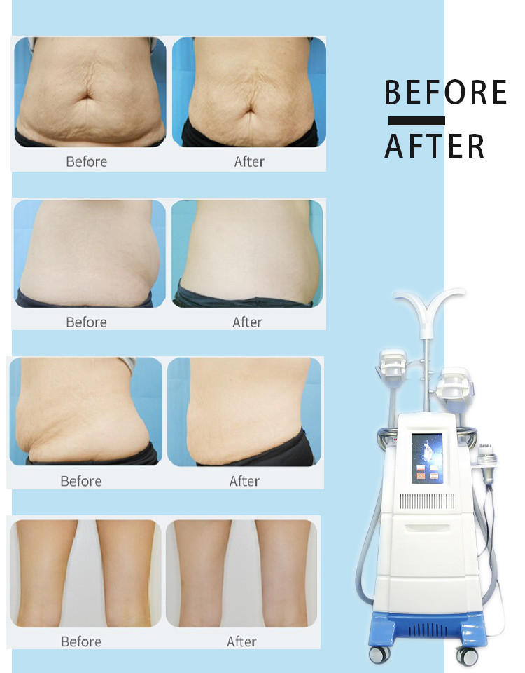 Hot sale !!! 4 Cryo handles cryolipolysis 5mhz rf cavitation cryolipolysis body slimming machine LF-207C