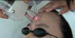 best selling Light spot 0.1mm USA fractional CO2 laser scar/ acne removal skin