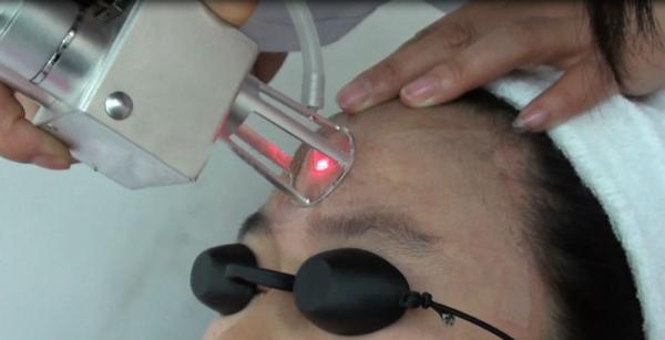 best selling Light spot 0.1mm USA fractional CO2 laser scar/ acne removal skin